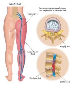 ισχαλγία πόνος στο πόδι/ μέση orthopedicare